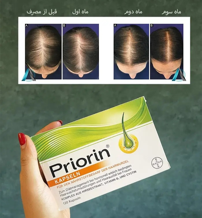 مکمل ضد ریزش مو پریوتین ۱۲۰ عددی